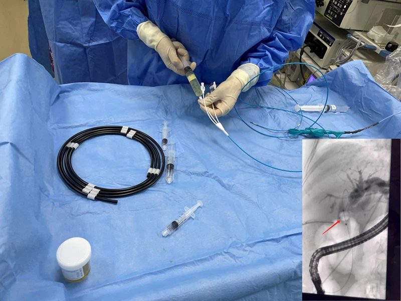 Los tres mejores hospitales locales de Hangzhou utilizan nuestro catéter con ...